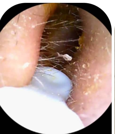 Nettoyage d'oreille numérique